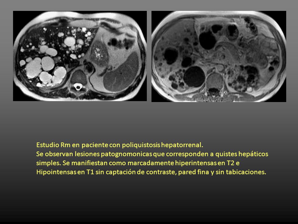 Complicado simple quiste hepatico